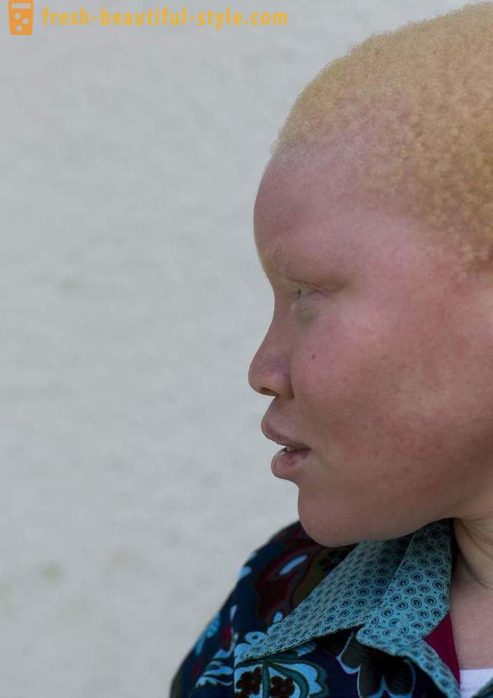Ang kalunus-lunos na kasaysayan ng Tanzanian albinos