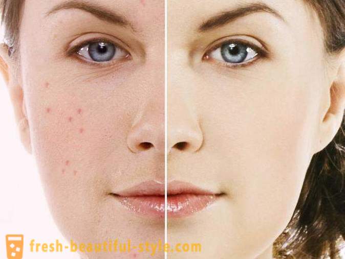 Badyaga mantsa ng acne: mga review. Badyaga (gel) ng mga spot edad